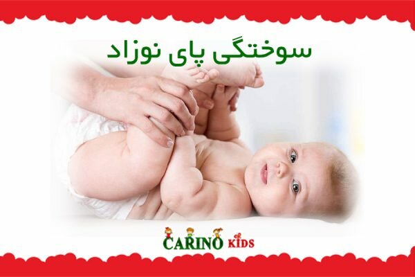 سوختگی پای نوزاد